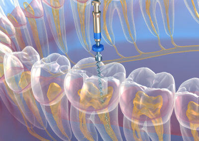 Endodoncja - Leczenie kanałowe Sopot - AS dent Klinika