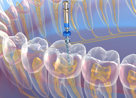 Endodoncja - Leczenie kanałowe Sopot - AS dent Klinika