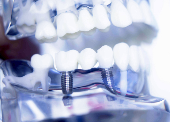 Implantoprotetyka Sopot - AS dent Klinika