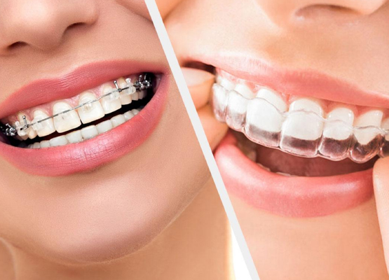 Ortodoncja - Aparaty na zęby Sopot - AS dent Klinika